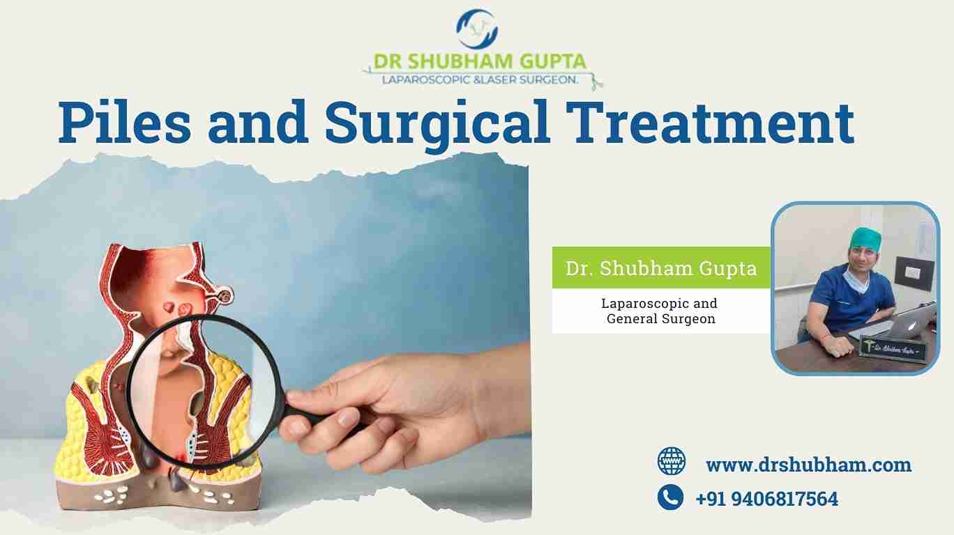 Understanding Piles and Surgical Treatment | Dr. Shubham Gupta