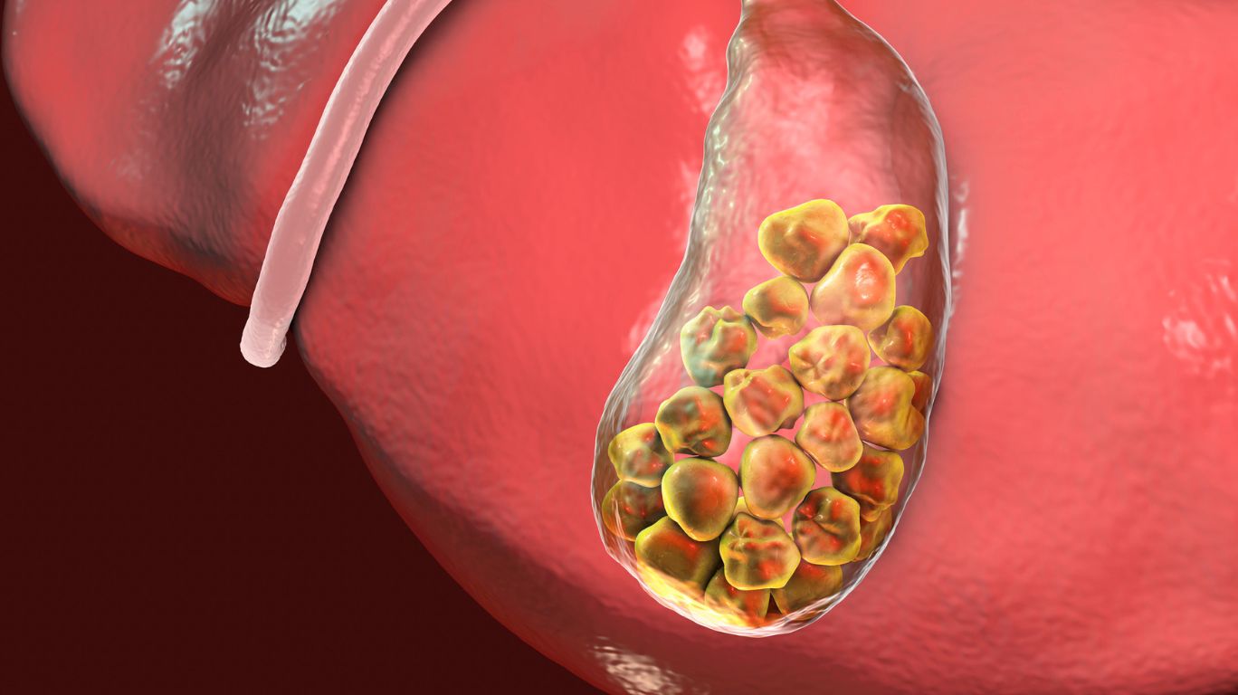 What are Gallstones? It’s Symptoms, Causes, Medication, Risk Factors