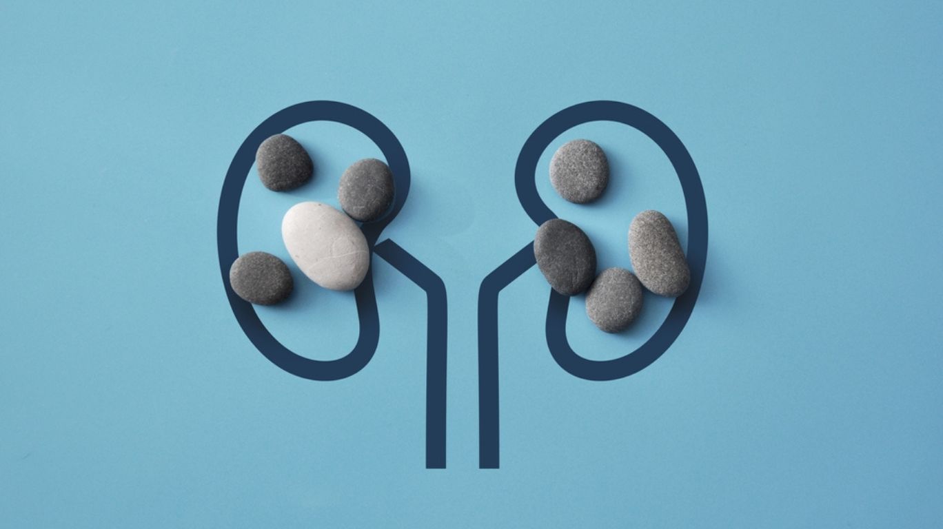 Kidney Stones – Things Need to Know
