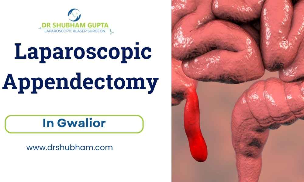Laparoscopic Appendectomy in Gwalior – Dr. Shubham Gupta